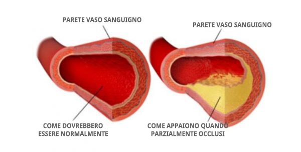 colesterolo i vasi sanguigni