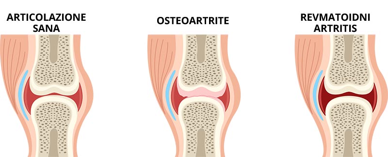 malattie delle articolazioni