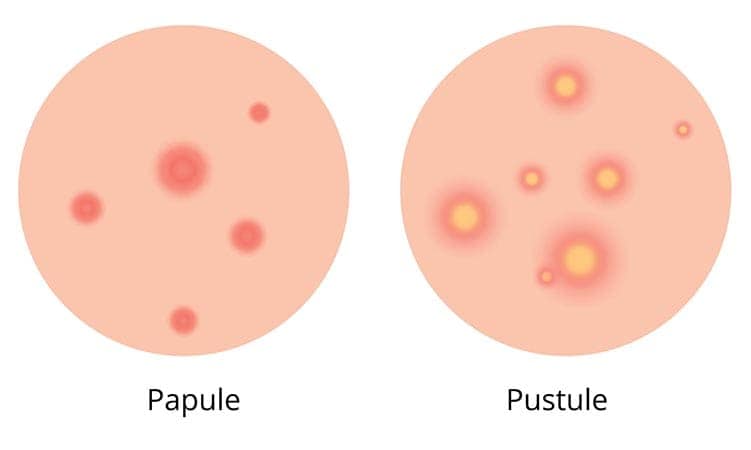 acne papulopustulosa