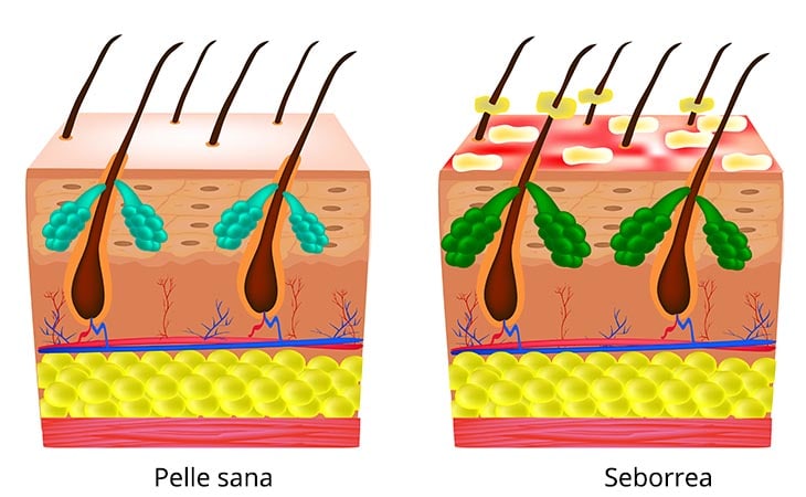 pelle sana - seborrea