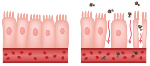 La sindrome dell’intestino permeabile